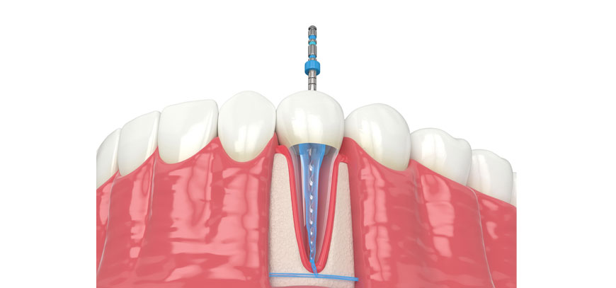 Ενδοδοντική Θεραπεία