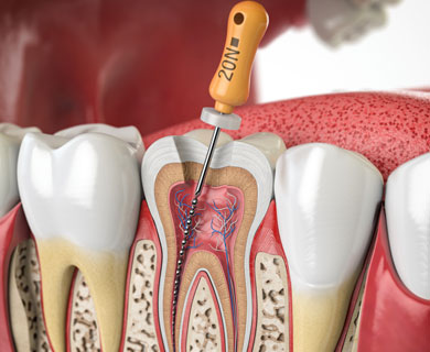 Ενδοδοντική Θεραπεία - Διαδικασία
