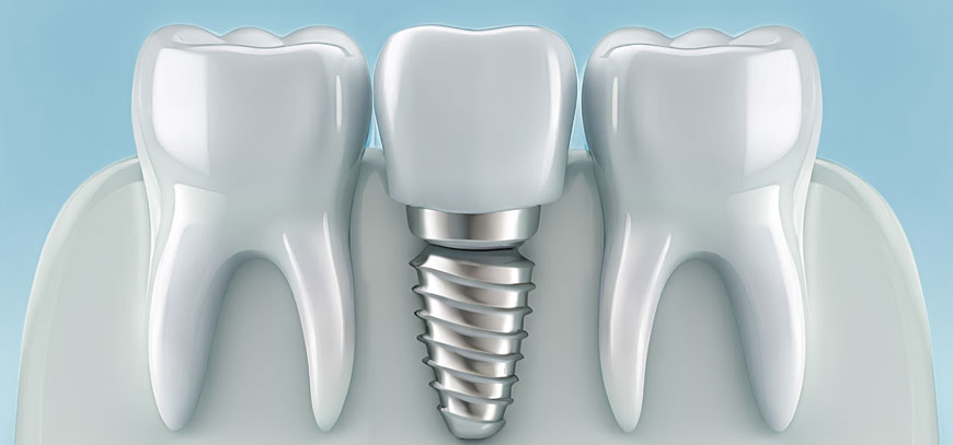Οδοντικά Εμφυτεύματα - Διαδικασία