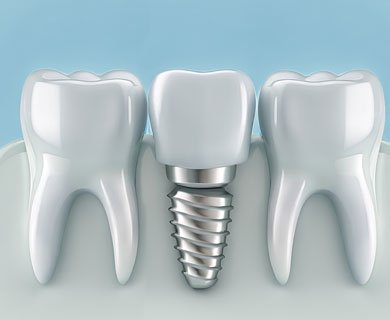 Οδοντικά Εμφυτεύματα - Τοποθέτηση