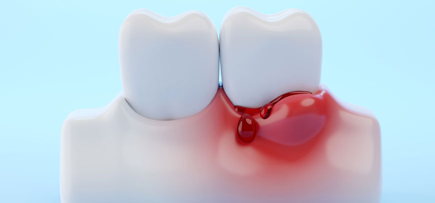 Ενδέιξεις Περιοδοντίτιδας