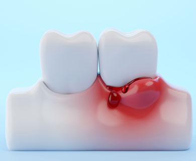 Περιοδοντίτιδα