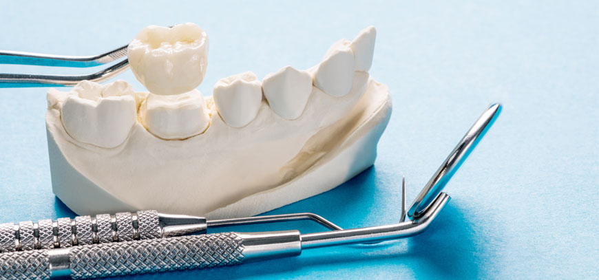 Προσθετική Δοντιών